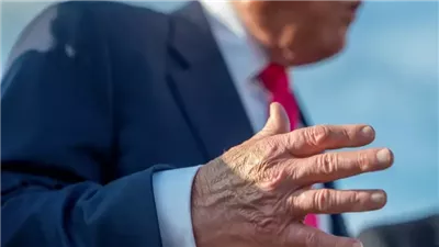 بعد ظهورعلامات غامضة على يد ترامب ... خبراء يكشفون الحقيقة وراء الكدمات المتكررة 