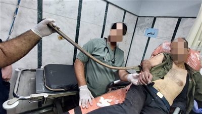 استخراج سيخ حديدي طوله متر ونصف من جسم مريض وإنقاذ حياته