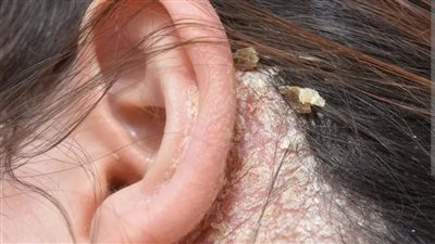 فطريات الشعر.. طرق العلاج وأبرز وسائل الوقاية للحفاظ على فروة رأس صحية