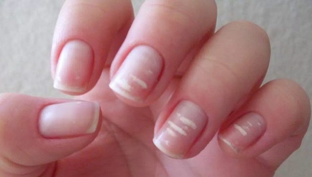 5 علامات على أظافرك تشير إلى نقص الفيتامينات