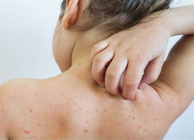 انخفاض في أوربا ووفيات في أمريكا.. آخر تطورات جدري القرود