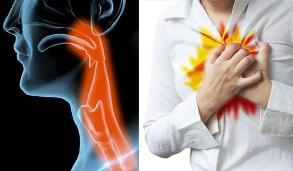 ارتجاع المريء