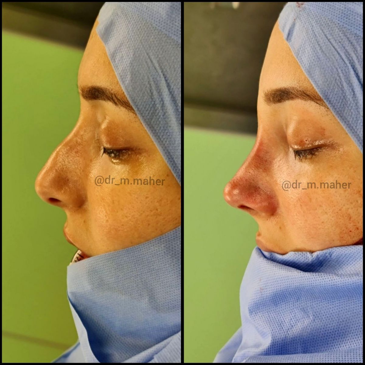 عملية تجميل الأنف التحفظي