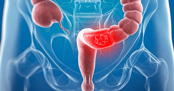 سرطان القولون