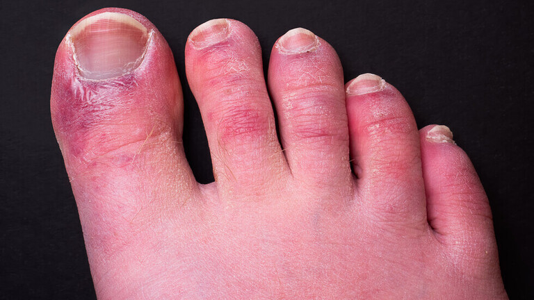 6 أسباب تجعل جلدك يتحول إلى اللون الأزرق