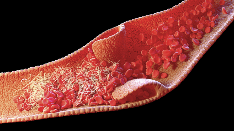 تجلطات الدم