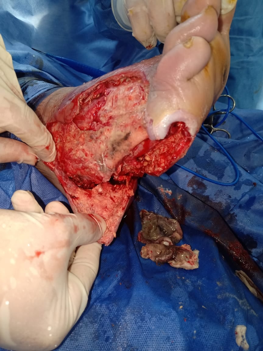 إجراء جراحة أوعية دموية بمستشفي بلبيس لإنقاذ مريض بالعناية المركزة