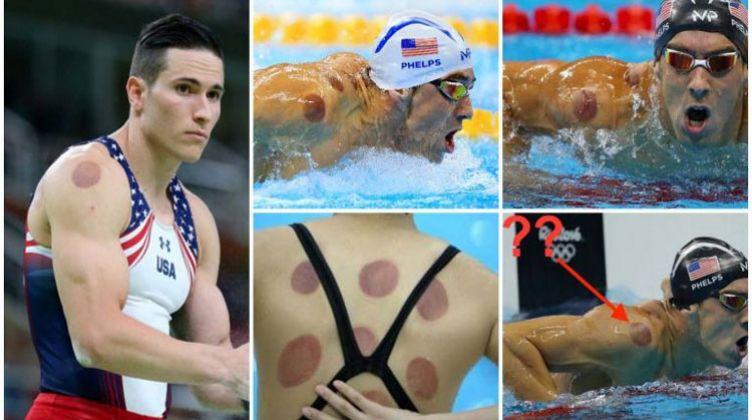 شاهد.. الحجامة طريق نجوم ريو 2016 لنيل الذهب